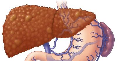 Відкрито ген, що підвищує ризик розвитку портальної гіпертензії