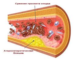 Особливості генома штовхають деяких до атеросклерозу