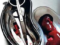 Людям почнуть пересаджувати органи свиней, прогнозують експерти