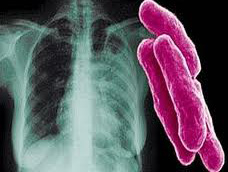 Хіміки підійшли ближче до позбавлення від туберкульозу