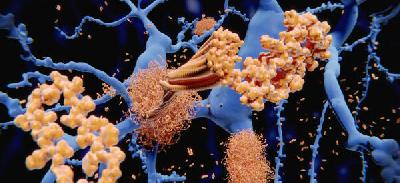 Дослідники виявили, як саме бета-амілоїд утворюється в нервових клітинах