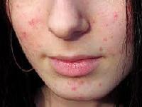 Акне може бути генетичною недугою, заявляють вчені