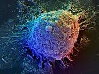 Вчені зрозуміли, чому при ожирінні рак грудей поводиться агресивніше