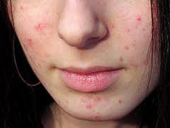 Група китайських вчених знайшла новий ген, пов'язаний з акне