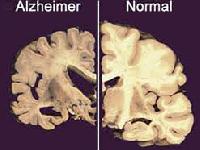 Простий аналіз крові виявить деменцію майже за 20 років до появи перших симптомів