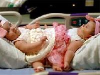 Стан стабільно важкий: сіамські близнюки на апараті штучної вентиляції легень