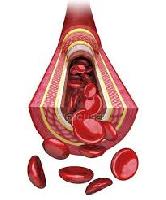 Вітамін, дефіцит якого послаблює стінки артерій