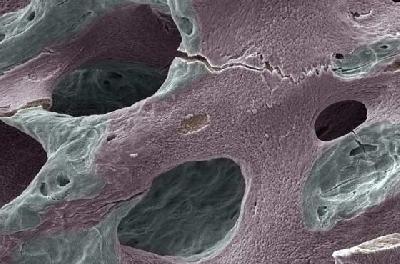 Американські вчені знайшли зв’язок між каменями в нирках та остеопорозом